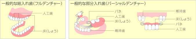 総入れ歯と部分入れ歯の違い