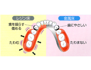 残っている歯に負担が少ないです
