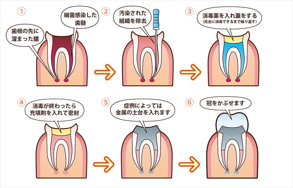 根管治療の流れ