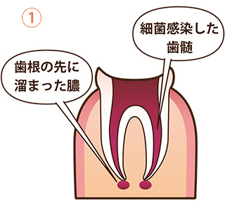 根管治療の流れ