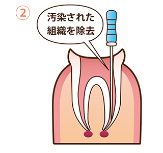 根管治療の流れ