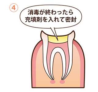 根管治療の流れ