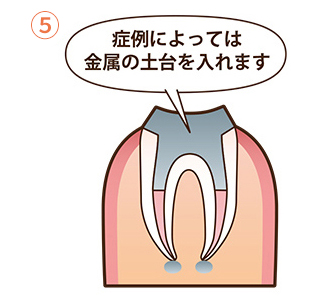 根管治療の流れ