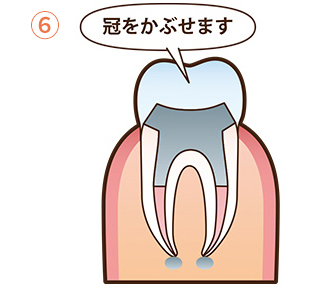 根管治療の流れ