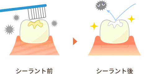 シーラント(小窩裂溝予防填塞)
