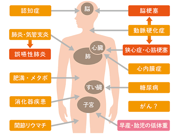 歯周病は全身疾患や早産などのリスクを高めることも