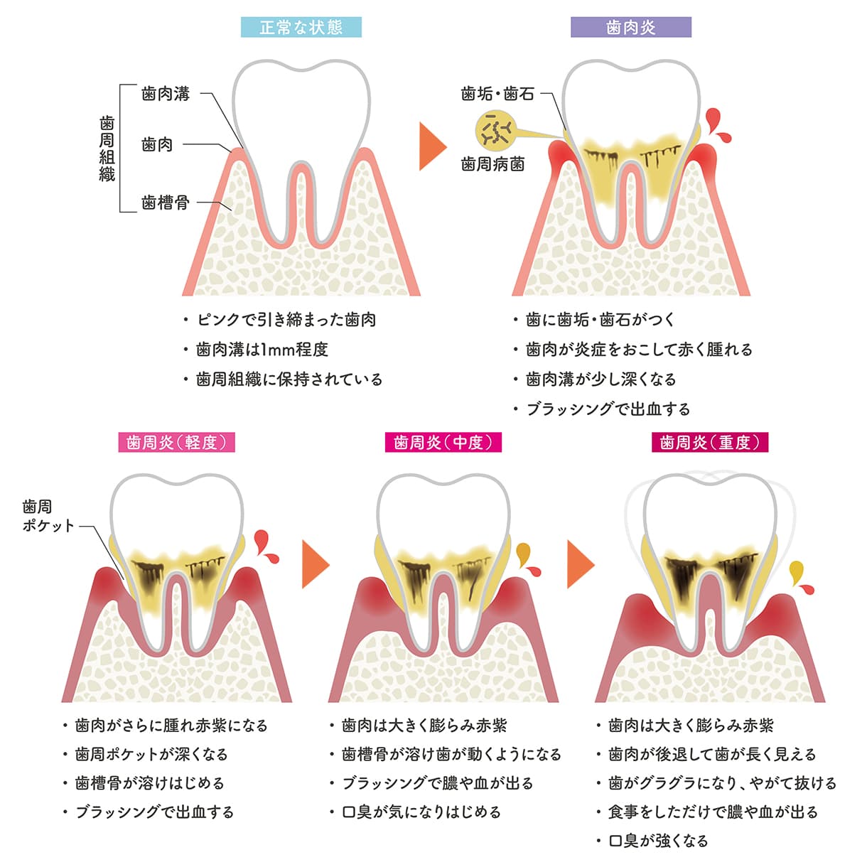 歯周病の進行とよくある症状