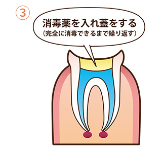根管治療の流れ