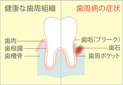 健康な歯周組織と感染した状態