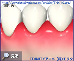 アニメで歯周病の進行の様子を見る